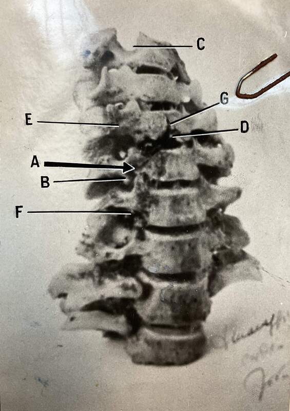 Le vertebre di Vincenzina Virando con l'indicazione dei segni dei proiettili