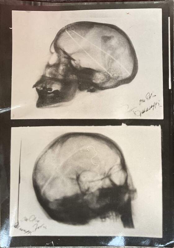 Riproduzione della radiografia del capo di Vincenzina Virando